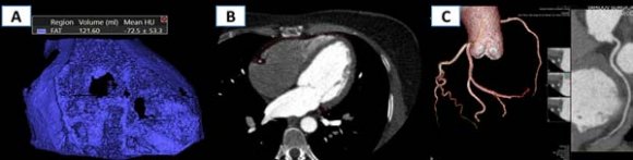 Figure 8: 65-year-old female patient. ?D-3D image of the EAT (A), axial projection with the designation of the EAT boundaries (B), curvilinear reconstruction of the CA with the presence of hemodynamically significant (HDS) areas of stenosis (C) (CAD-RADs 4).