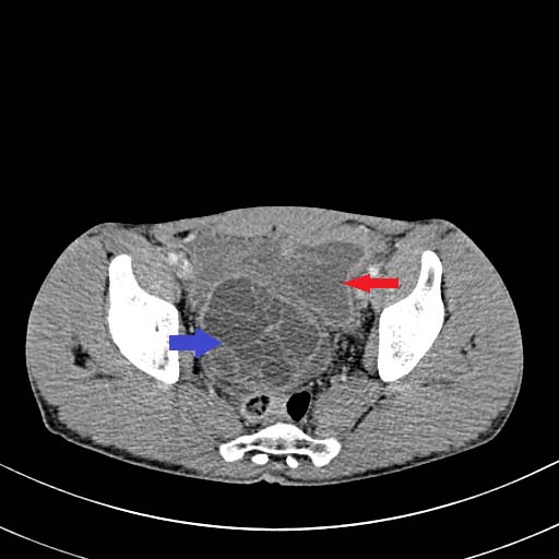 Fig. 2: AP radiograph pelvis(A) showing mild sclerosis of bilateral femoral heads with normal contour.MRI T1,T2 axial (B,C)and STIR coronal images(D) showing Geographical areas of altered signal intensity areas which are heterogeneously hyperintense on T1,T2 with surrounding hypointense rim with central suppression and peripheral hyperintense rim on STIR in both femoral heads. F/S/O bilateral grade II AVN.