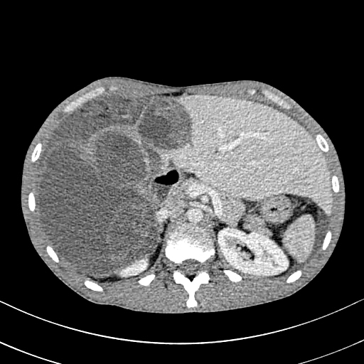 Figure/Patient 1 A 7 year-old girl presenting with a tumefaction at the level of the right latero-cervical region. US scans show a 43x14 mm subcutaneous fluid formation with septa extending from the root of the neck to the submandibular region (A-B). Doppler-mode demonstrates lack of blood flow within the lesion or the septa (C-D). Diagnosis of cystic lymphangioma is done.