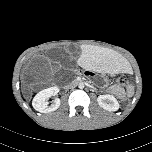 Figure/Patient 3An 8 year-old girl with prior surgical excision of a right latero-cervical lymphangioma presenting with a new-onset tumefaction within the same region. MRI scans show a 9-10 cm subcutaneous multilocular lesion, extending between two virtual planes crossing the retro-molar trigone and the thyroid respectively, with deep invasion of parapharyngeal spaces cranially and the space between the submandibular gland and the vascular peduncle of the neck caudally. The lesion appears hyper-intense on T2 weighted scans with (A-B) and without (C-D) fat suppression, hypo-intense on T1 weighted scans with (E) and without (F) fat suppression and hyper-intense on DWI scans with high B values (G). Diagnosis of loco-regional recurrence of cystic lymphangioma is done.