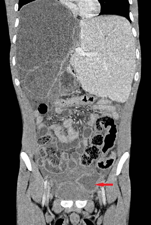 Figure/Patient 5 A 6 year-old boy presenting with a right latero-cervical tumefaction (A-B): axial (C) and coronal (D) MR scans show an expansive subcutaneous formation with high T2-signal, consistent with lymphangioma. The patient is demanded for sclerotherapy with ethanol: after disinfection and sterilisation of the skin (E), a fine needle is introduced into the lesion (F) and a yellowish viscous fluid is aspirated (G); then, alcohol is injected into the lesion (H). No recurrence is visible at two months-follow up (I-L).