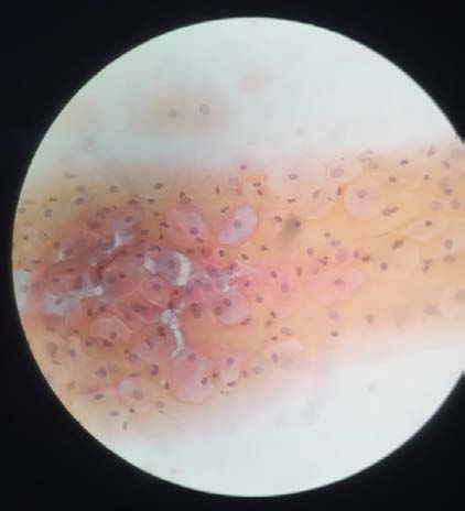 Figure 1: Atrophic smear -Patient A (preprocedure).