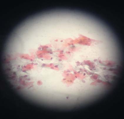 Figure 3: Atrophic smear-Patient B (preprocedure).