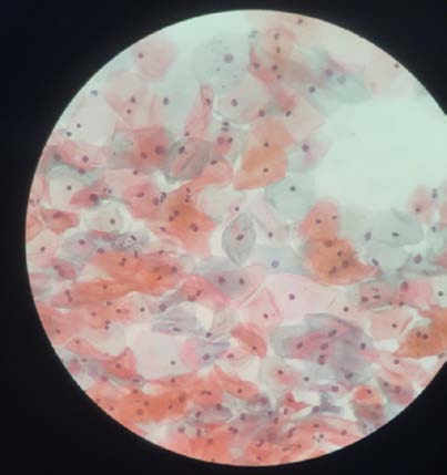 Figure 4: Normal smear -Patient B (postprocedure).