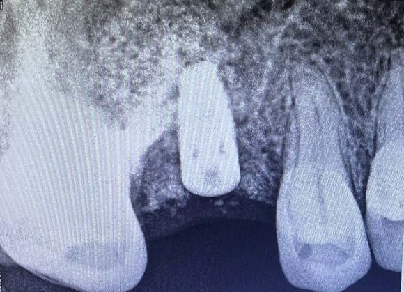 Instructions to the patient post-treatment