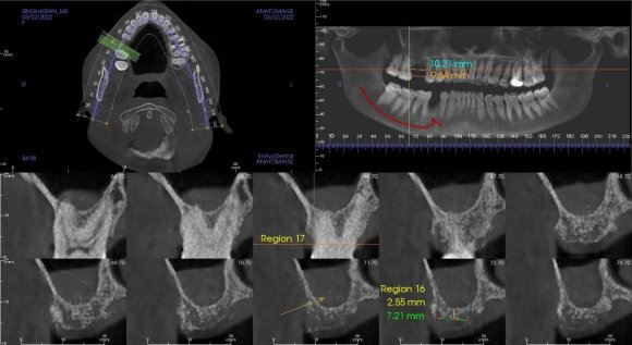 Examen endobuccalL'examen endobuccal montre une supraclusion incisive, une DDM et un sens transversal correct. Dans le sens sagittal, on note une classe II dentaire. examen radiographique, on observe que les dents de sagesse ont été enlevées. Orthopantomographie de début de traitement.