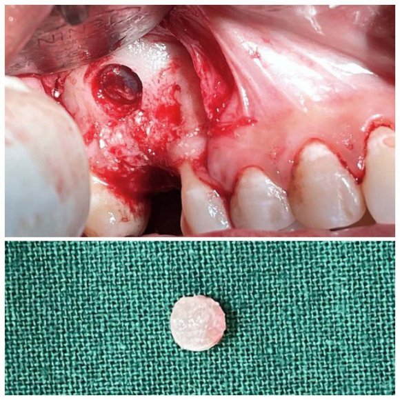 'ancrage est mis en traction par un ressort NiTi de 300 grammes mis en place de façon simple après l'intervention. L'extrémité postérieure du ressort NiTi est fixée sur la partie toronnée du fil d'ostéosynthèse. L'extrémité antérieure du ressort est connectée à l'appareil multi bagues inférieur par une ligature métallique. Il s'agit dans ce cas d'une traction directe. Dans le cas de notre patiente, la distalisation débute sur un arc à mémoire de forme de section .020 x .020. Vue du système de traction du côté droit, gauche, puis en vue occlusale. Les premiers résultats sont obtenus rapidement. La traction n'a pas besoin d'être réactivée à chaque rendez-vous.