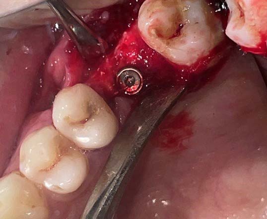 Téléradiographies de profil: comparaison entre l'image de début de traitement et l'image de contrôle après 6 moisde traction sur l'ancrage par fil dans la branche montante mandibulaire. L'angle incisif est passé de 112 à 90,3°.Tout au long du traitement, le patient ne s'est plaint d'aucune gêne due à ce système de traction et elle l'a même décrit comme « confortable ». Le système a été déposé au cours de la chirurgie orthognathique. L'opération a été réalisée par le Dr Paul CRESSEAUX, au cours du 7 ème mois de traitement.