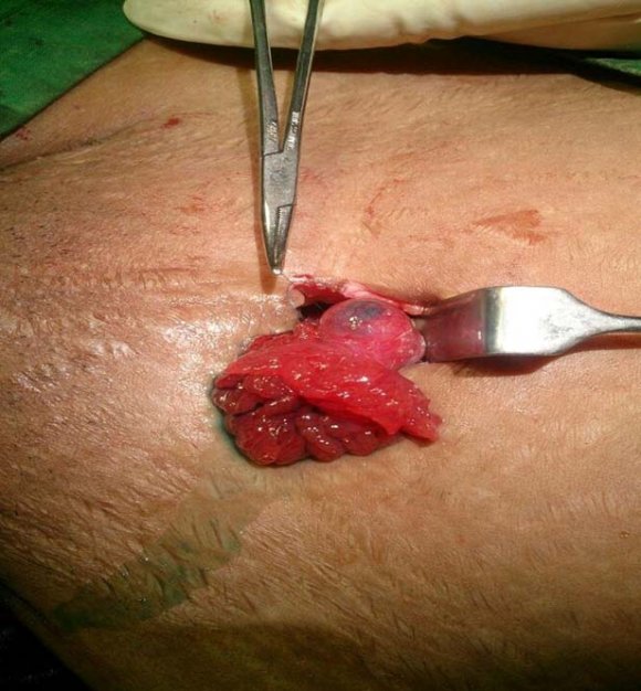 Figure 1: Patency of dye confirmed with methylene blue dye