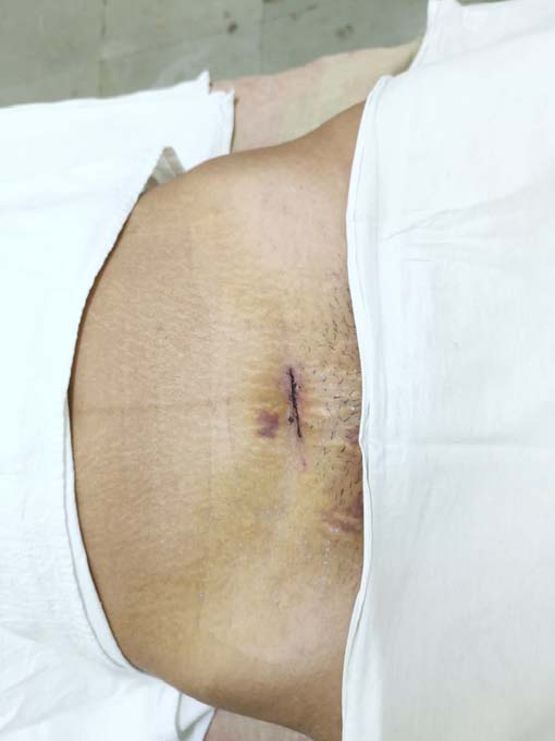 Figure 2: Incision line of microsurgical tuboplasty (2 to 2.5cm)
