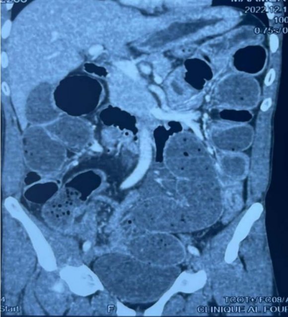 Occlusal relation of the maxillary left third molar (1) Level1, (2) level 2, (3) level 3 Occlusal relation of the maxillary right third molar (1) Level1, (2) level 2, (3) level 3 Occlusal relation of the mandibular left third molar (1) Level1, (2) level 2, (3) level 3 Prevelance of Patterns of Impactions in the State of Punjab-A Retrospective Research Analysis Table 8: Occlusal relation of the mandibular right third molar (1) Level1, (2) level 2, (3) level 3
