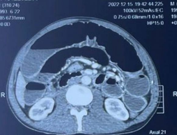 Ramus relationship of impacted maxillary left third molar, (1) class 1, (2) class 2, (3) class Ramus relationship of impacted maxillary right third molar, (1) class 1, (2) class 2, (3) class 3 Prevelance of Patterns of Impactions in the State of Punjab-A Retrospective Research Analysis Ramus relationship of impacted mandibular left third molar, (1) class 1, (2) class 2, (3) class 3 Ramus relationship of impacted mandibular left third molar, (1) class 1, (2) class 2, (3) class 3 Prevelance of Patterns of Impactions in the State of Punjab-A Retrospective Research Analysis IV.