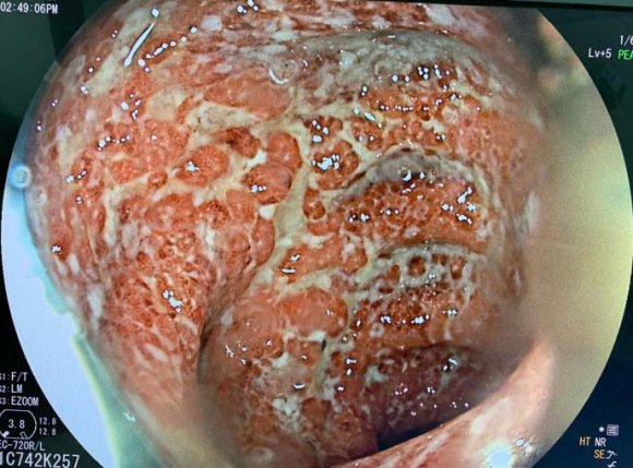 Figure 6 Figure 1-6: endoscopic aspect of ulcerative colitis attack