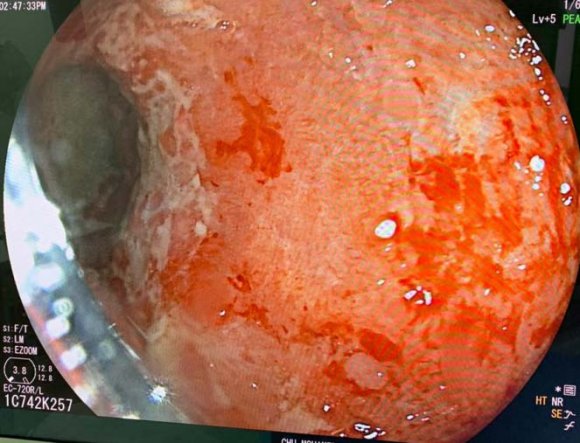 Figure 7: Post-surgery aspect of the colon