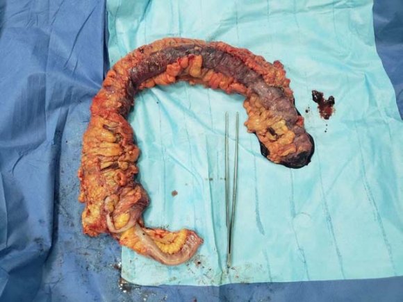 Figure 8: Equential study of clinical features (top), treatment (bottom), and changes in binding activity of doublestranded DNA (DS-DNA) and radioiodinated (1251) complement (Clq)(18).