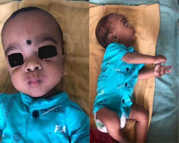 On February 16th, he attended the consultation with the responsible physician who, associated the symptoms with the anticonvulsant and switched to Phenytoin 100mg twice a day and associated Dexamethasone orally. It evolved five days later with intermittent hiccups and prostration that lasted approximately three days.Cerebrospinal fluid (CSF) collected On March 21st revealed a cell count of 0 unit; glucose 89 mg/dL, lactate 15.7 mg/dL, gram without staining bactéria, and CSF culture without bacterial growth.He was hospitalized on March 24th for social reasons to collect WD screening tests. The patient presented to the neurological examination with regular general condition, good spatial orientation, alertness, Glasgow Coma Scale 15, hypomimia, cranial nerve pairs exam without abnormalities, isochoric pupils, normal extrinsic ocular motricity, risus sardonicus, deep tendon reflexes 2/2, muscle strength 5/5 in all testable upper and lower limb muscle groups, somaesthesia, right-hand flexor dystonia, and ataxic gait. Upon slit lamp examination, the presence of Kayser-Fleischer rings was noted.Laboratory workup of March 24th revealed aminotransferase (AST) 37 mg/dL, alanine aminotransferase (ALT) 35 mg/dL, total bilirubin test 1,00 mg/dL, albumin test 3,7 mg/dL, international normalized ratio (INR) 1,17, and platelets 88x10 9 /L. Tests for disorders of Copper metabolism of the same date revealed total serum copper 24,6 mg/dL (reference range (RR) 70mg/dL-150mg/dL), serum ceruloplasmin 7,0 mg/dL (RR 20mg/dL-60mg/dL) and, finally, 24hours urine copper test 187,4 mg/dL (RR 70mg/dL-150mg/dL). Child-Pugh, Fibrosis-4, and APRI scores were, respectively, 5 points (Child Class A -least severe liver disease); 1,99 (undetermined), and 1,11 (significant fibrosis most likely, cirrhosis undetermined). Abdominal ultrasound exam of April 8th, 2022, indicates chronic liver disease with signs of portal hypertension, splenomegaly, and moderate ascites. Electroneuromyography of March 14th, 2022, was absent abnormalities.