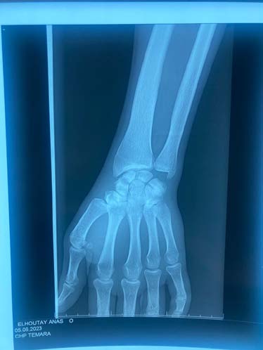 Figure 1: The standard X-ray of the wrist, in frontal and oblique views, revealed a displaced fracture of the scaphoid on a lacunar image located in the middle portion of the scaphoid.