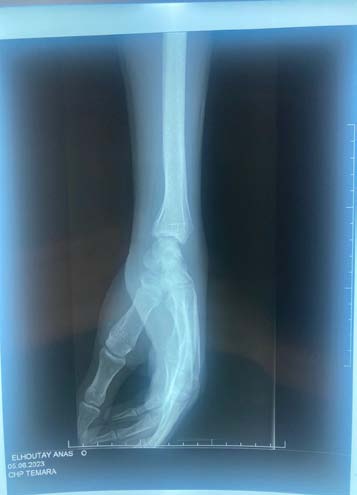Figure 2: The computed tomography (CT) scan confirmed the scaphoid fracture and the localized and nonaggressive nature of the cyst.