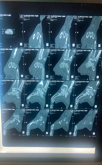 Figure 3: Postoperative radiograph after curettage, grafting, and stabilization with two pins.