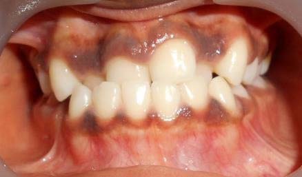 Figure 1: Treatment of an anterior reverse bite.