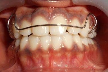 Fig. 1: (A) Drills the Neodent (Group N) made of surgical stainless steel (440C). (B) Drills in the Dentoflex group (Group D) were made of surgical stainless steel (XM-16).