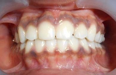 Fig. 3: Infrared placed at the intersection of the drill/model surface