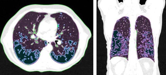 Figure 1: Visual representation of emphysema (blue), normal tissue (pink), and fibrosis (green)
