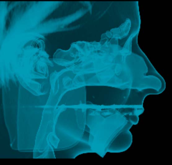 Fig. 1: KC cephalometric Xrays and analysis before and after Surgery showing Narrowness of the retro-basi-lingual area before surgery
