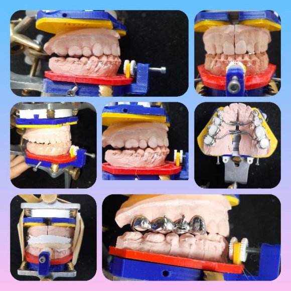 Fig. 8: Counter clockwise rotation of the maxilla induces secondary counter clockwise rotation of the mandible