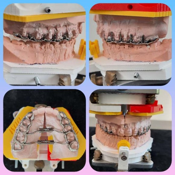 Fig. 10: The Genioglossus is the transmission "belt" to the advancement of the hyoid bone thus to the enlargement of the Retro-Basi-Lingual area or low Pharyngal area II.