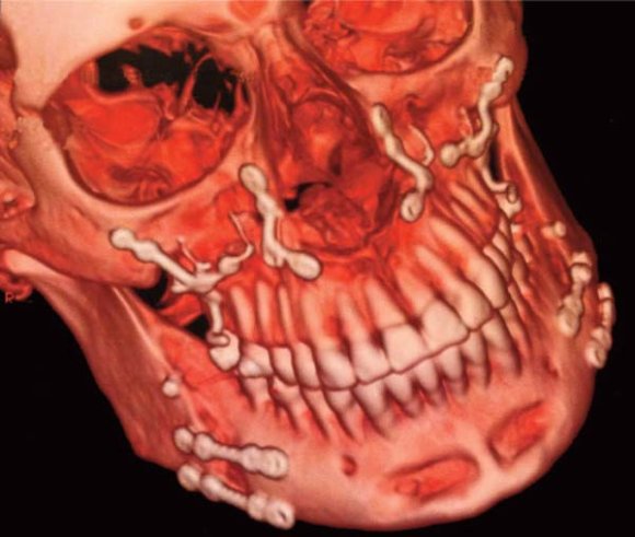 Fig. 12: A: Nasal fossae and open sinus views of Maxillary 4 pieces osteotomies in closed bird wings giving flexibility to the palatal vault thus avoïding tearing of the palatal mucosa. B Oral palatal view of the Piggy back Chrome-Cobalt dual-screw-expander i. The Dual-Screw-Expander was devised in my office in 1987