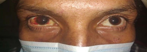 Rare Case of Purtscher's Retinopathy Seen in RTA Patient