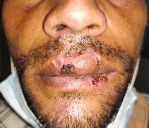 Figure 1: Photo showing RE subconjunctival hemorrhage