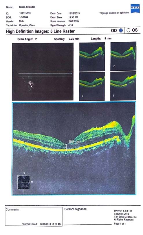 Figure 5: Macula OCT of both eyes showing normal macula contouro