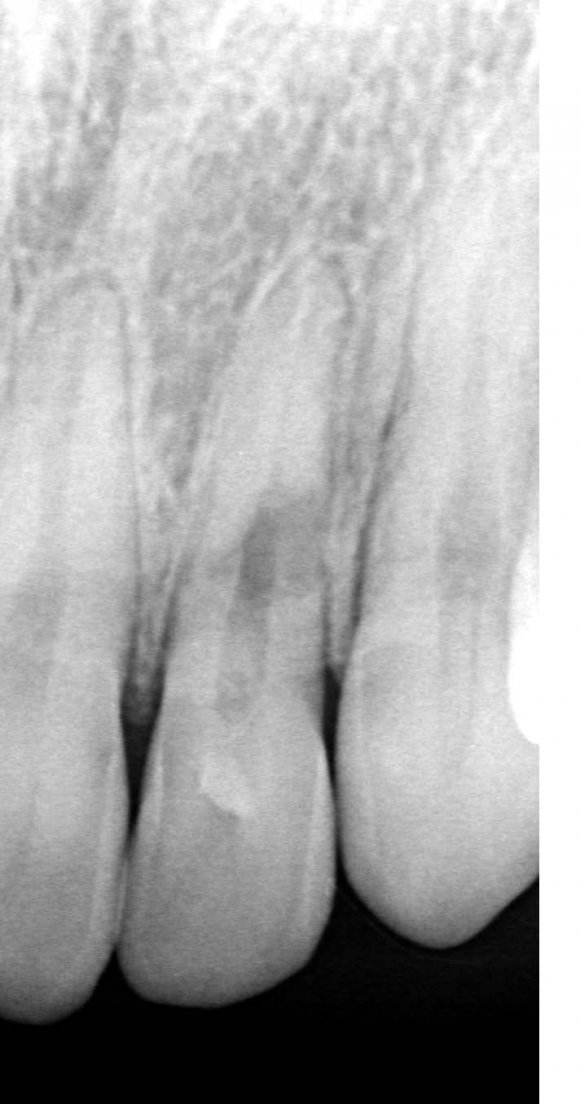 Figure 1: Distribution of different solutions and negative and positive controls. s.a: artificial saliva, NiTi: Nickel-Titanium, CuNiTi: Copper-Nickel-Titanium, S.a: Syzygium aromaticum, C.a: Celtis australis, Hyd: hydrosol.