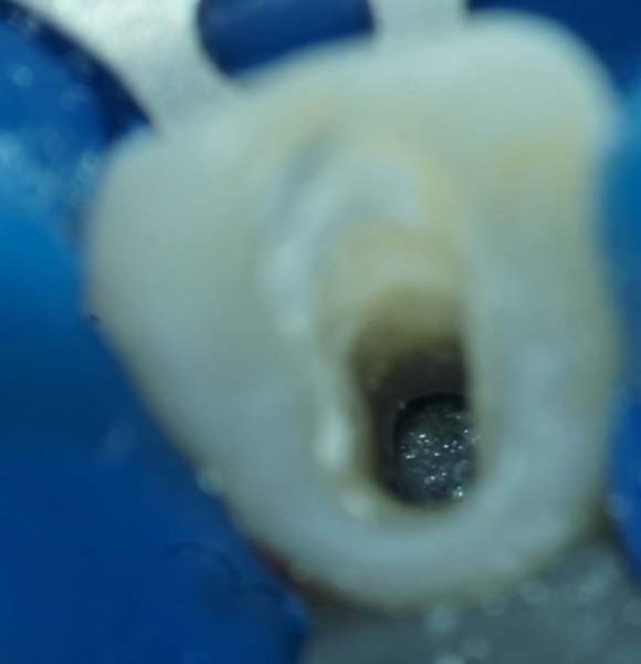 Figure 4: Microscopic images of Tetrahmyena thermophila and tetrahymena pyriformis taken after 48 hours of growth at x 100 magnification, showing the comparison of growth in artificial saliva and the usual medium PPYE b) Cytotoxic effect of orthodontic archwires on TetrahymenaIn the presence of NiTi or CuNiTi orthodontic archwires, the growth of Tetrahymena thermophila is significantly reduced by 50% and 60% respectively compared to controls (Artificial saliva) (p <0.01) (Figure5).The same results are noted in Tetrahymena pyriformis the growth of Tetrahymena pyriformis is