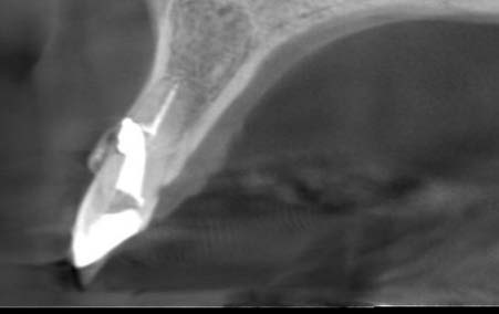 Figure 10: Microscopic images of Tetrahymena thermophila and tetrahymena pyriformis taken after 48 hours of growth at x 10 magnification, showing the comparison of their form in artificial saliva and the presence of NiTi and CuNiTi + the hydrosol of Syzygium aromaticum. S.a: Syzygium, S.A: artificial saliva.