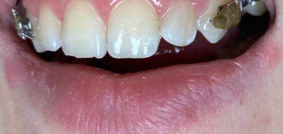 Figure 12: Evolution of the growth of Tetrahymena thermophila and Tetrahymena pyriformis in the presence of the extract, essential oils and the hydrosol alone. The differences are statistically significant if p <0.05, very significant if p <0.01 and very very significant if p <0.001. S.A: artificial saliva, C.G: clove, C.a: Celtis australis, H.E: essential oil.