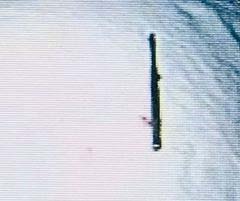 Metallic Dental Burr as an Iatrogenic Foreign Body in Maxillary Sinus-A Case Report IV.