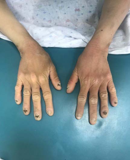 Fig. 1: Hyperkeratosis of the popliteal pits.